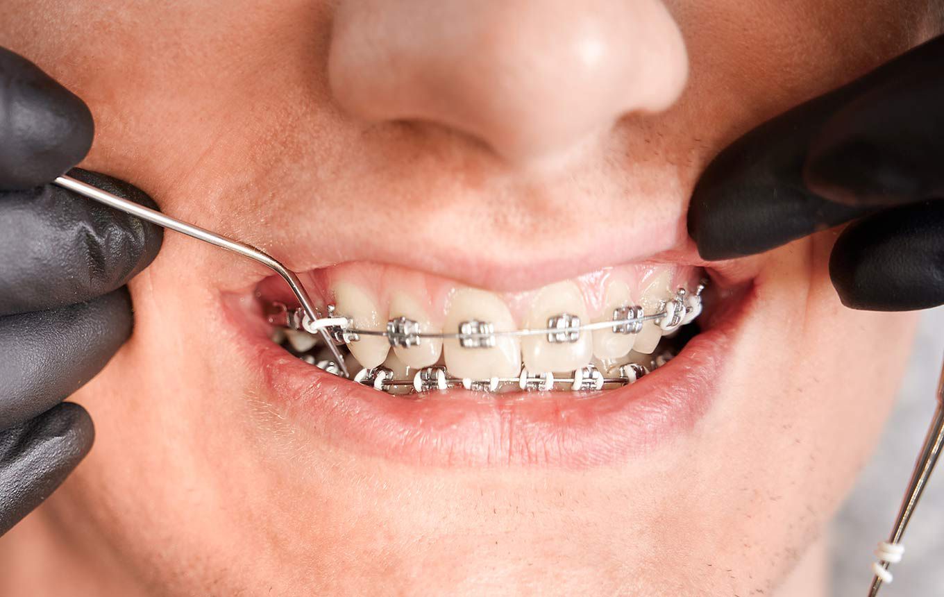 Σιδεράκια - brackets